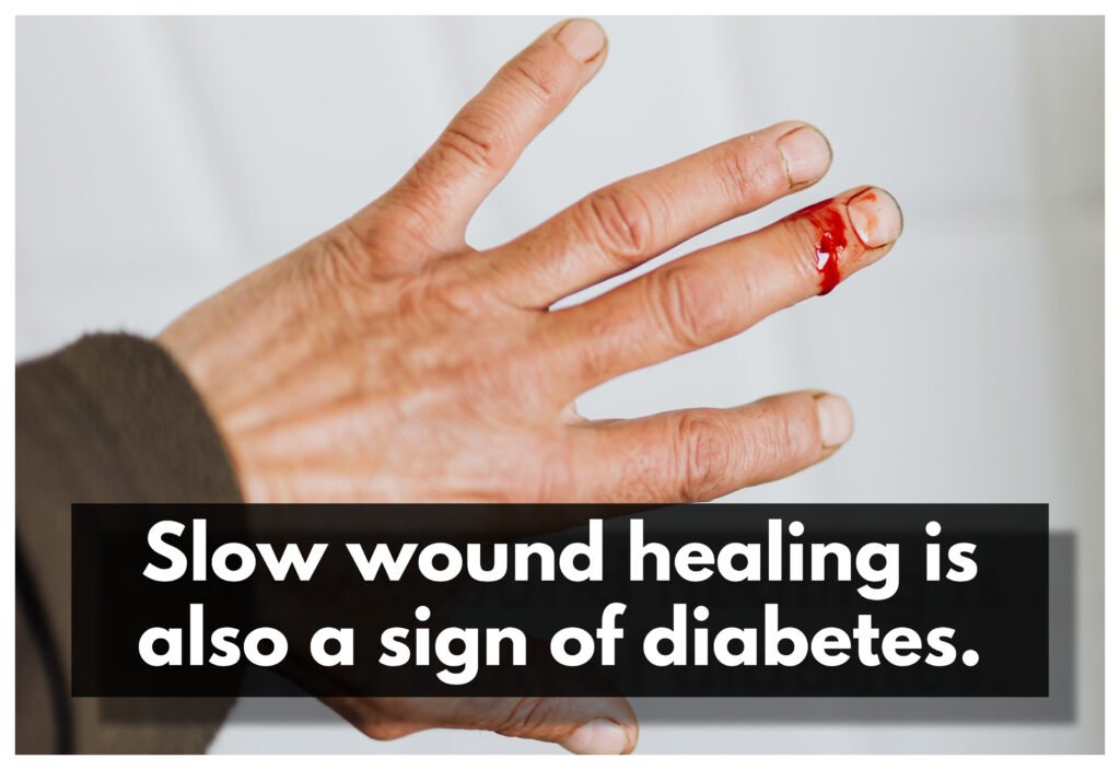 An image of a wounded hand with text "slow wound healing is also a sign of diabetes"
