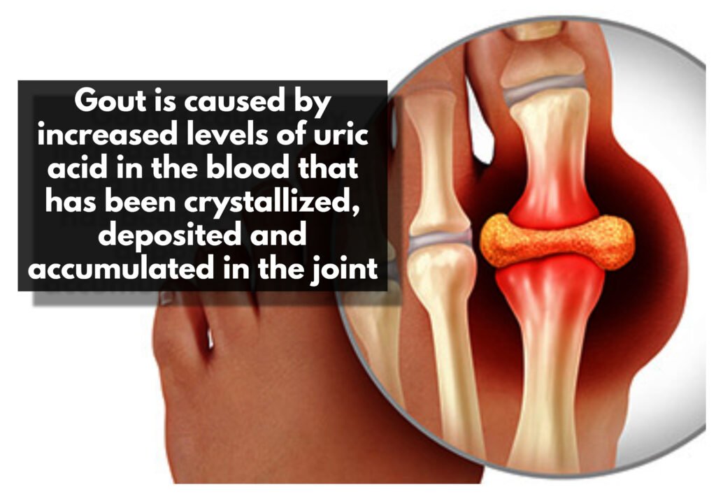 The pain and inflammation associated with gout can be very draining, leading to fatigue.