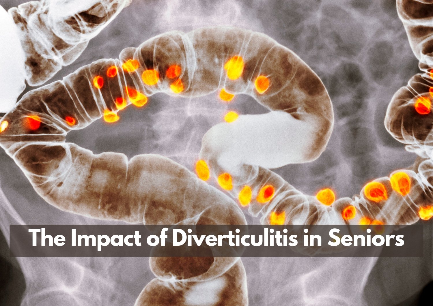The Impact of Diverticulitis in Seniors