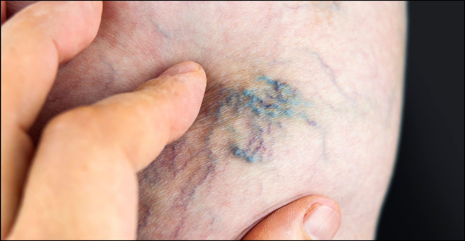 Seniors' Varicose Veins: A Common Problem with Surprising Solutions