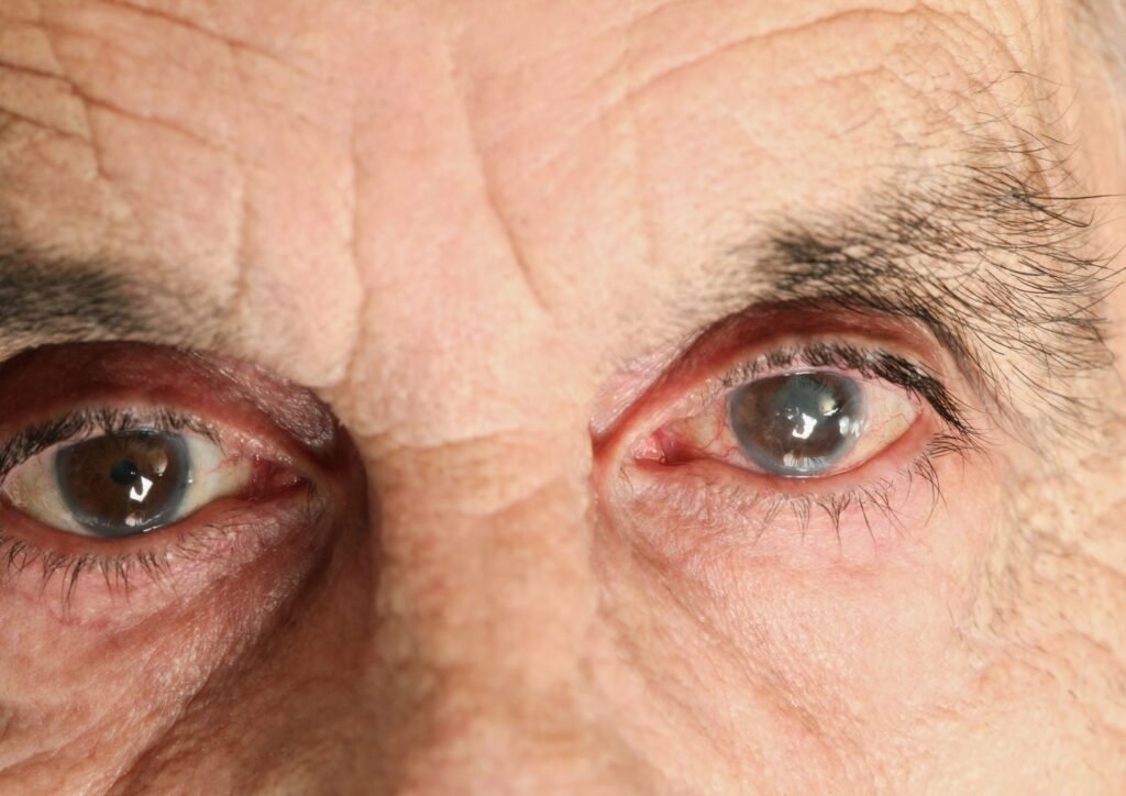 A senior with cataract on one of his eyes.