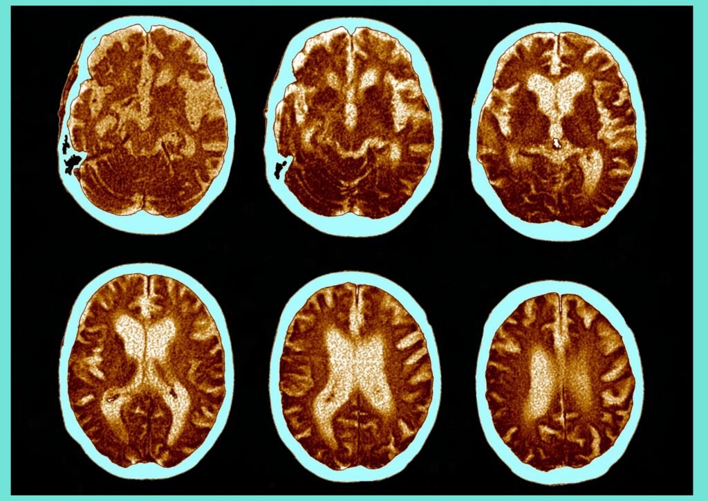 Sensory stimulation is important in therapy for Alzheimer's patients due to declining cognitive and physical abilities.